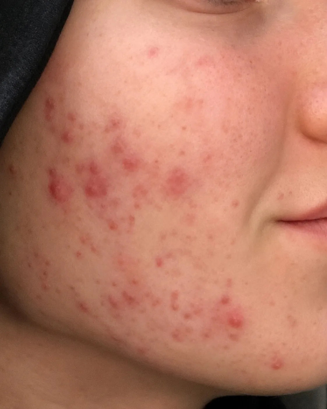 Akneramt kindparti før brug af CØLM Redness Relieving Cream