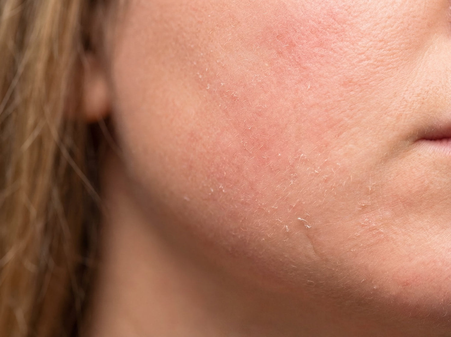 Ødelagt hudbarriere: Tegn, årsager og vejen tilbage til sund hud - NIMO SKIN