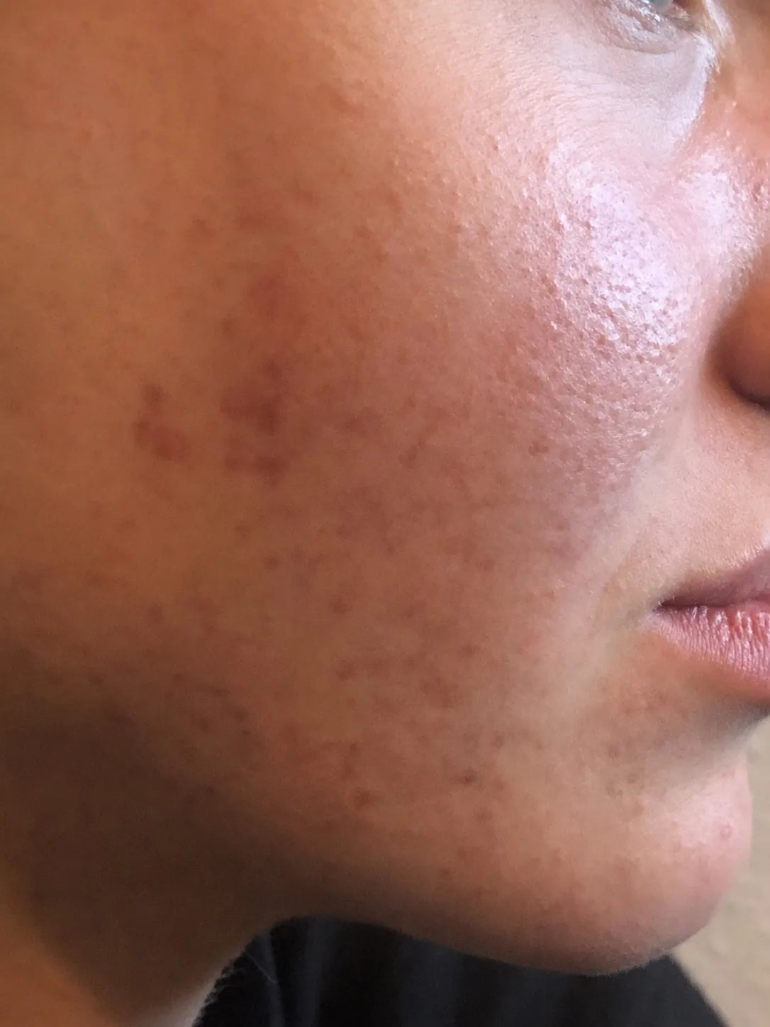 Samme kindparti efter brug af CØLM Redness Relieving Cream